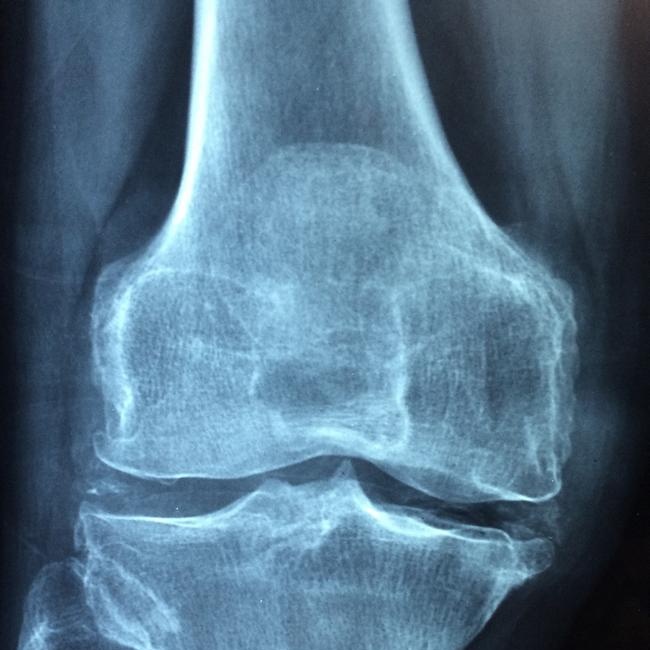 Tips for preventing knee pain